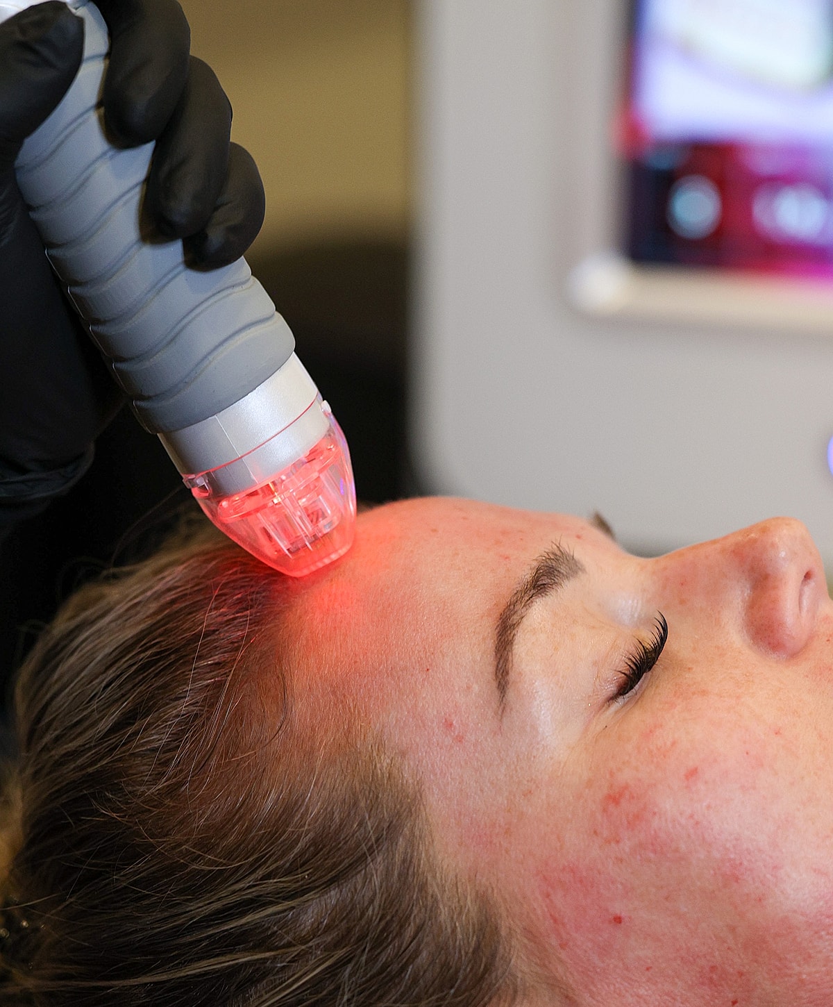 Laser treatment applied to a woman's forehead.