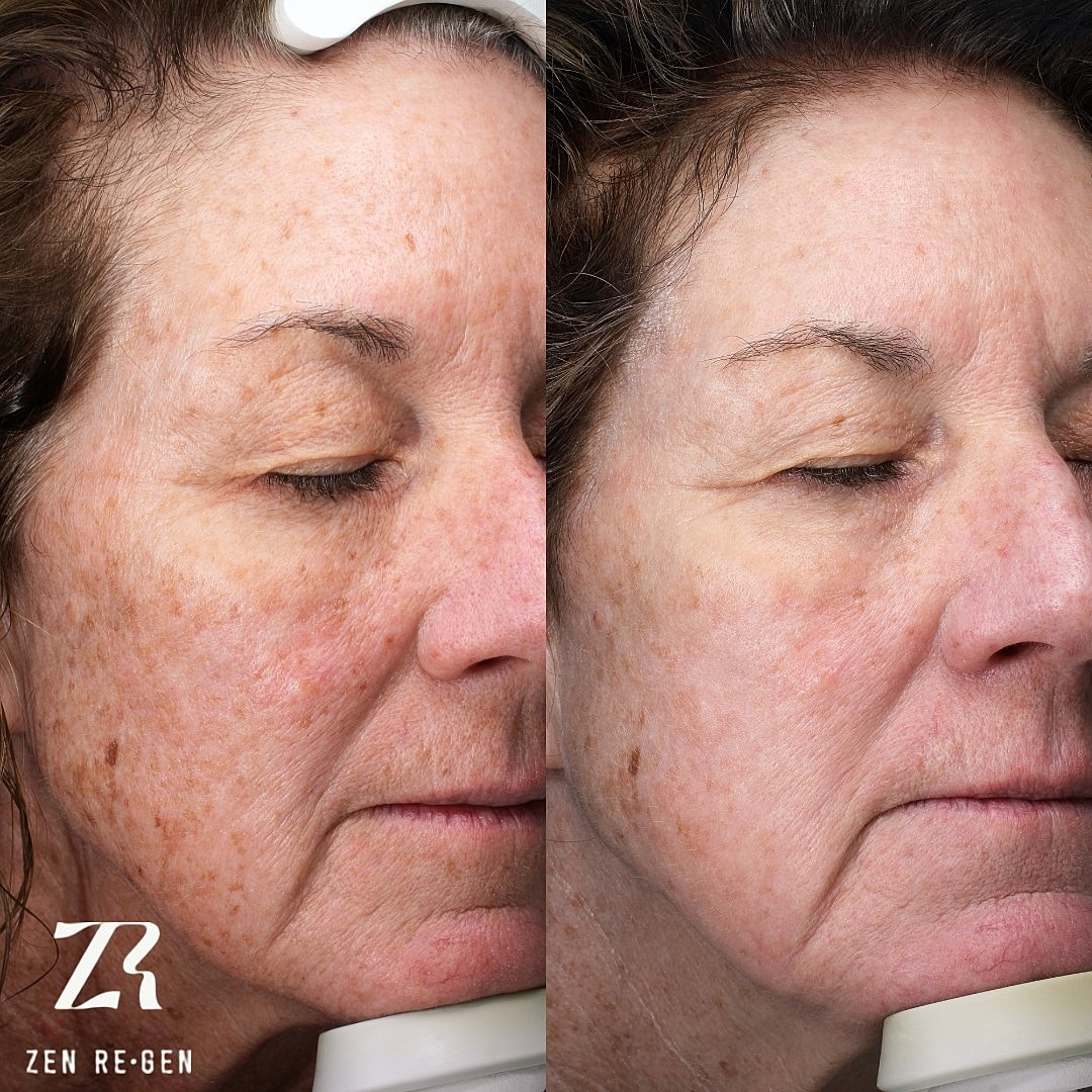 Before and after skincare treatment results.