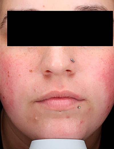 Vbeam Before & After