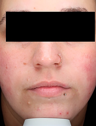 Vbeam Before & After