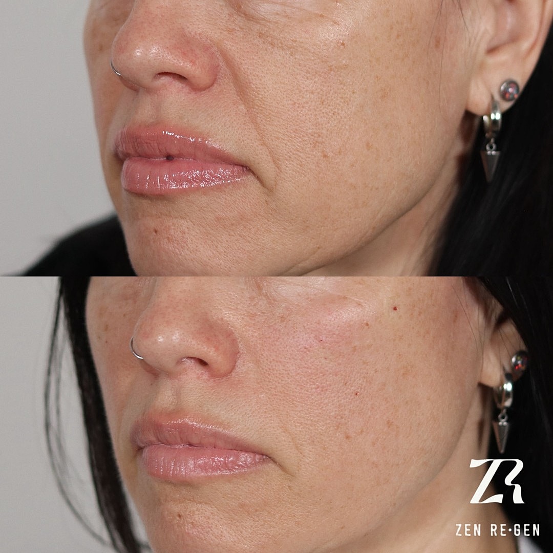 Before and after skincare treatment comparison.