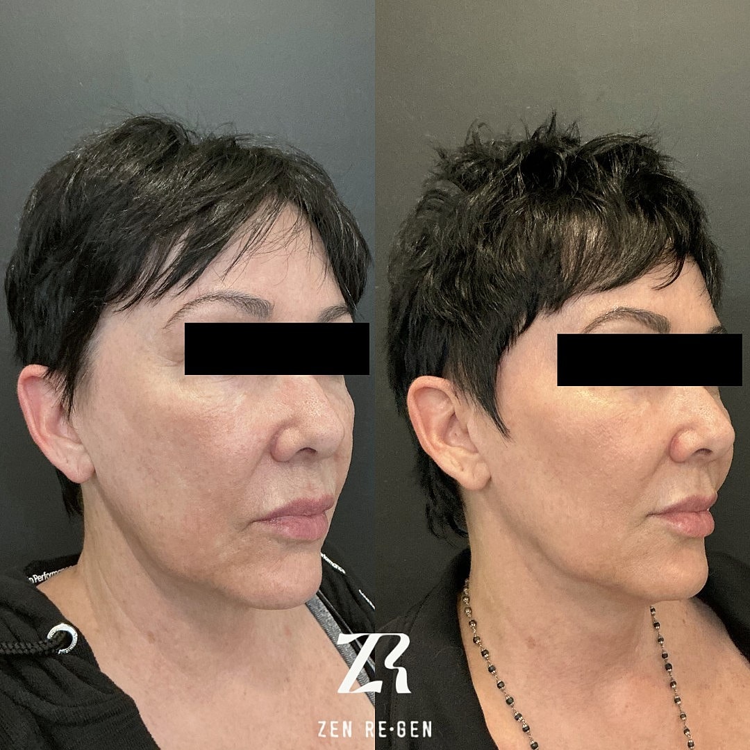 Before and after facial treatment comparison image.
