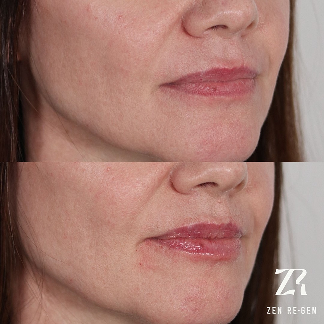 Before and after skin treatment comparison.