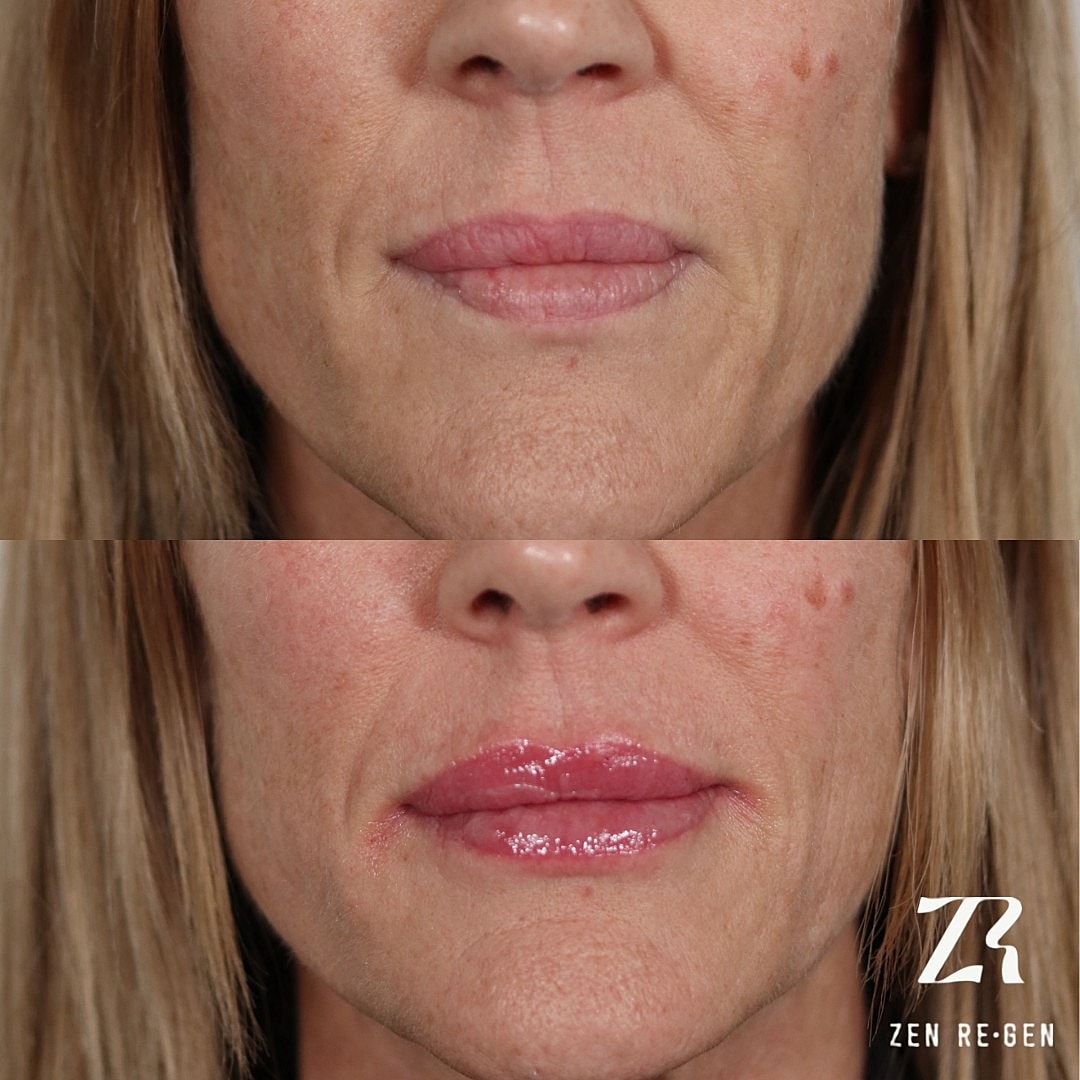 Before and after lip treatment results.
