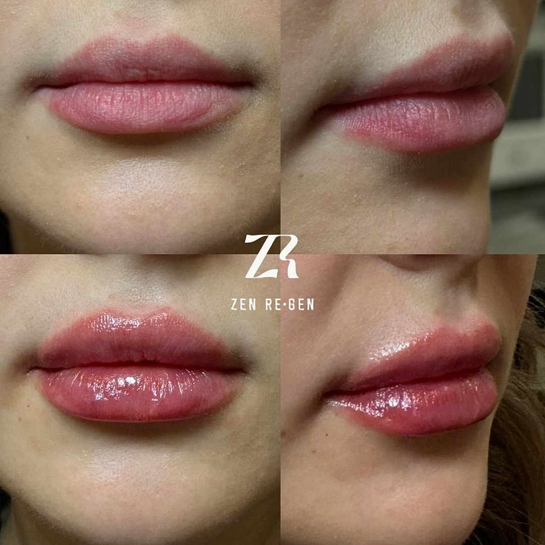 Before and after lip treatment photos.