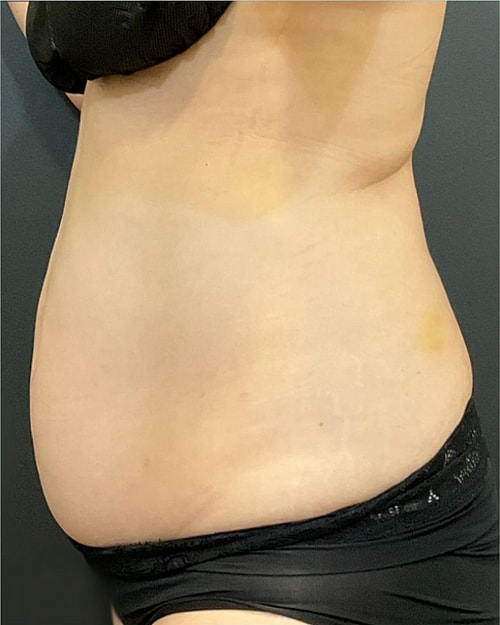 Coolsculpting Before & After