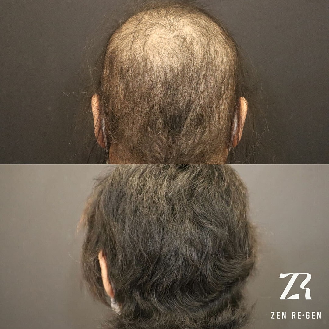 Before and after hair restoration transformation.