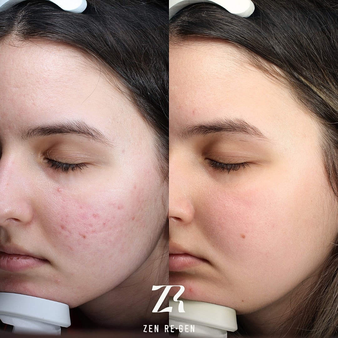 Skin transformation before and after treatment.