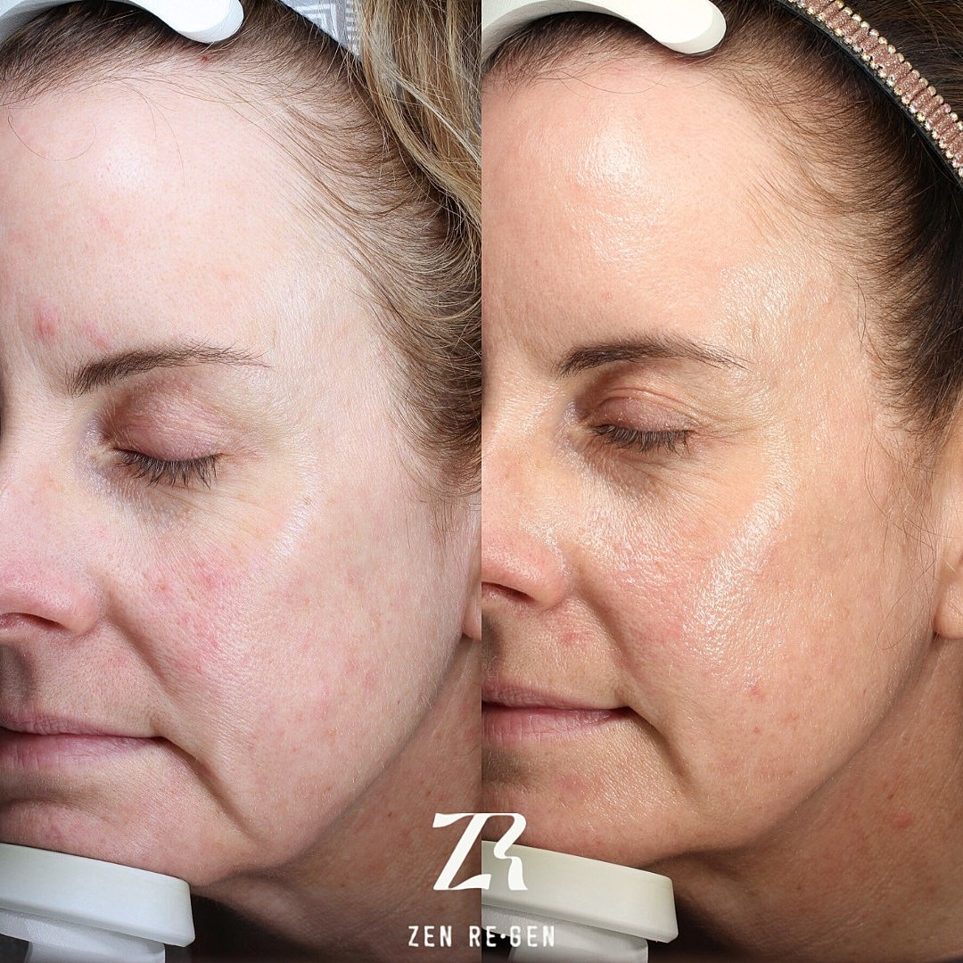 Before and after facial skin treatment comparison.