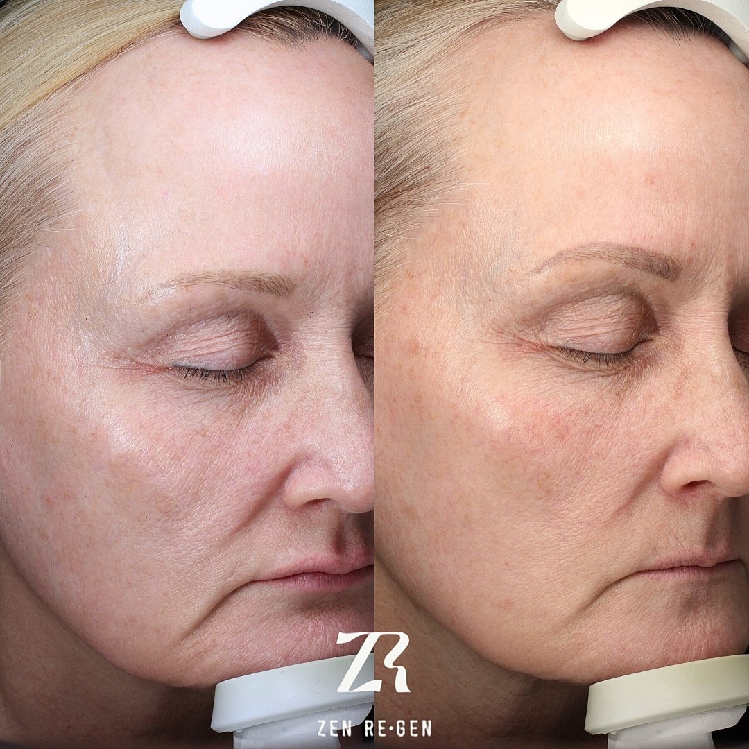 Before and after facial treatment comparison.