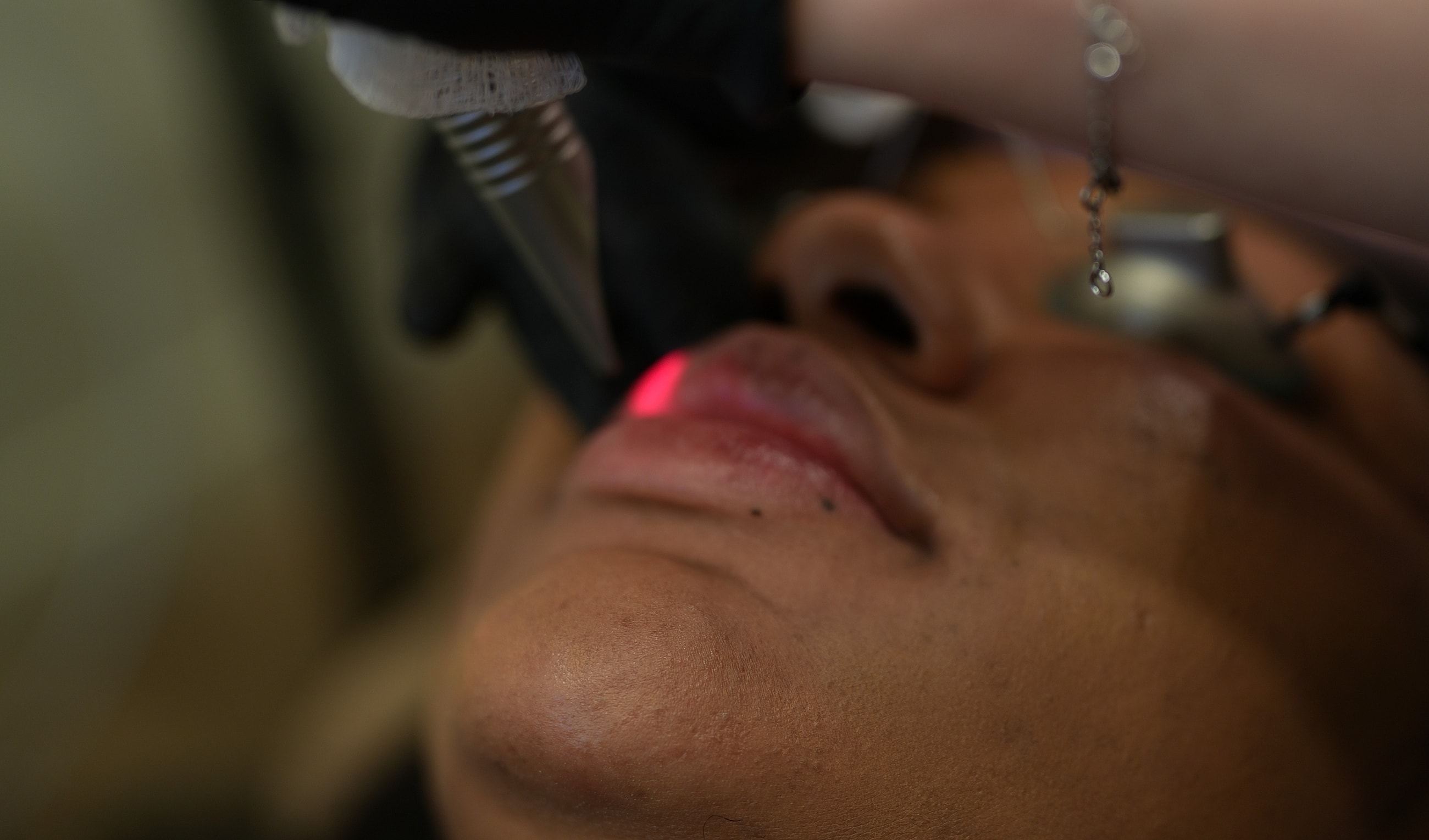 Lip treatment with laser procedure in progress.