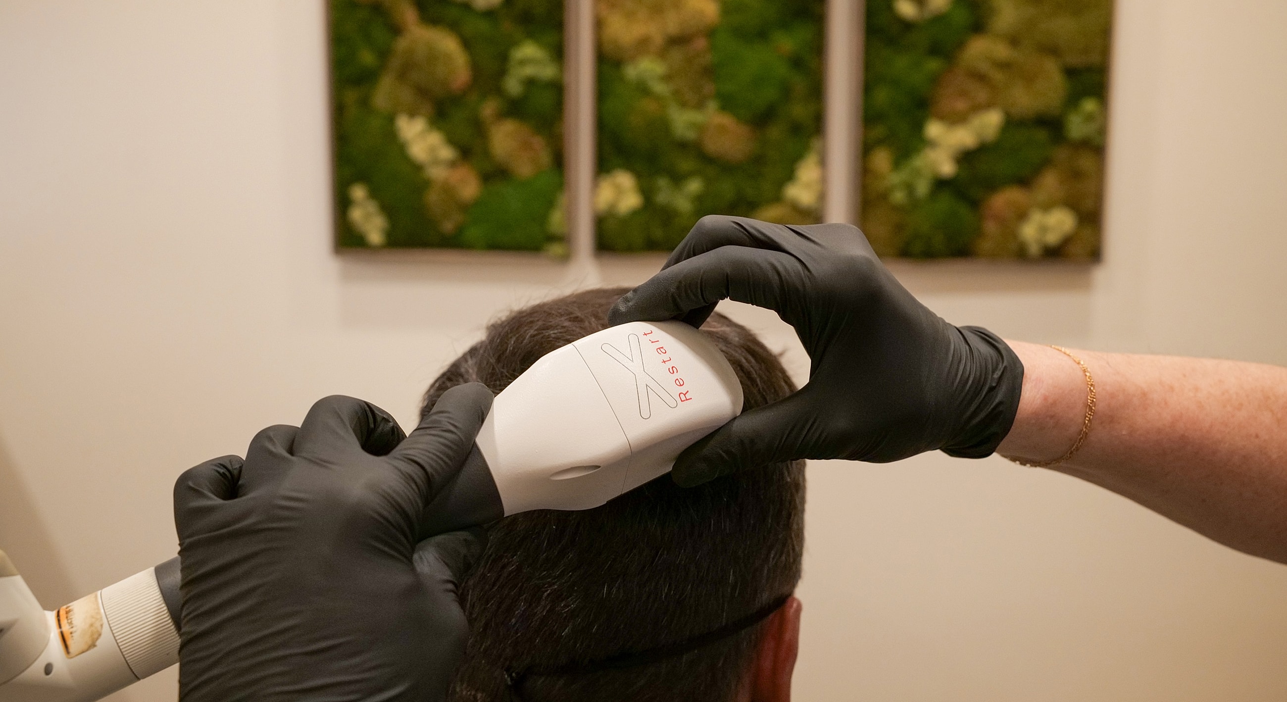 Hair treatment using laser technology on patient’s scalp.
